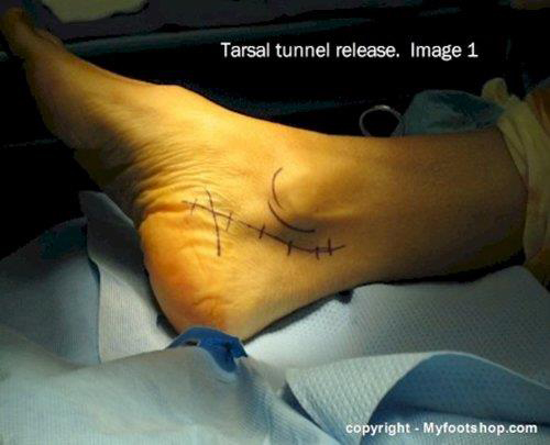 Nerveindklemning i fod (tarsaltunnelsyndrom) - Fodkirurgi, ankelkirurgi, nedgroet hammertå -